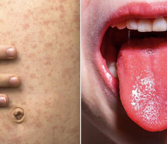 EE.UU confirma relación entre el covid-19 y un nuevo síndrome inflamatorio en los niños